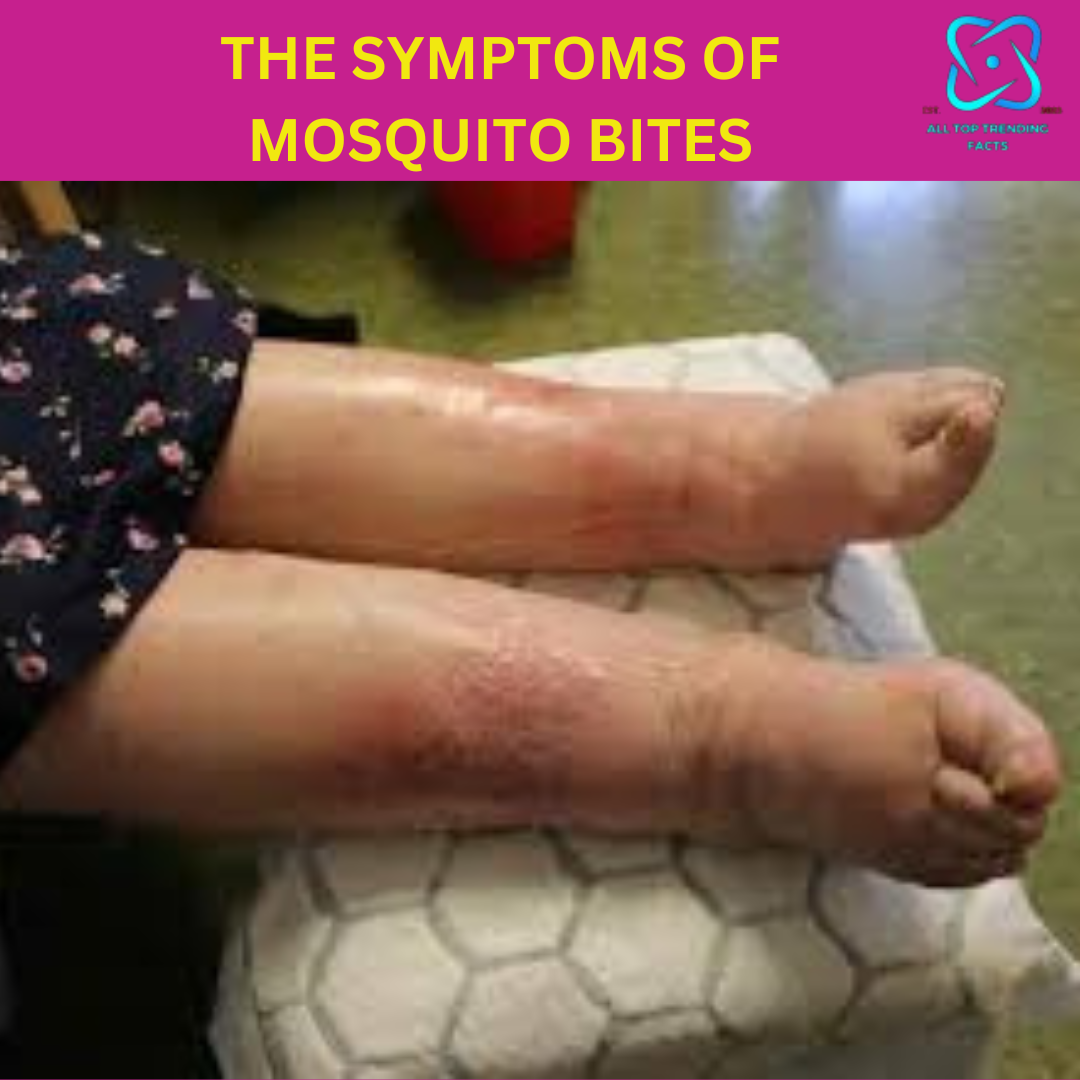 the symptoms of mosquito bites